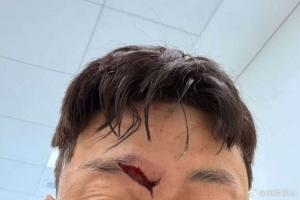 慎入！高准翼眉骨处裂开一道大口子，比赛中头部相撞赛后已缝针