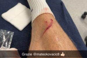 误伤自己人！哈兰德晒照：训练中小腿被科瓦契奇踢出一道血痕