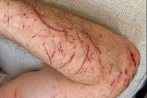 55岁希勒骑自行车时受伤：手臂、腿部多处割伤和擦伤